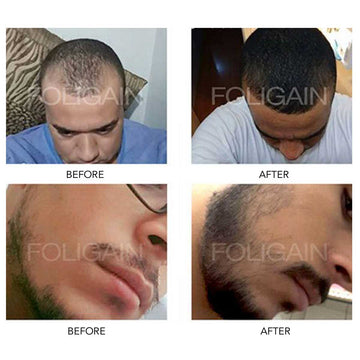 Before-and-after photo comparisons of a hairline and beard.