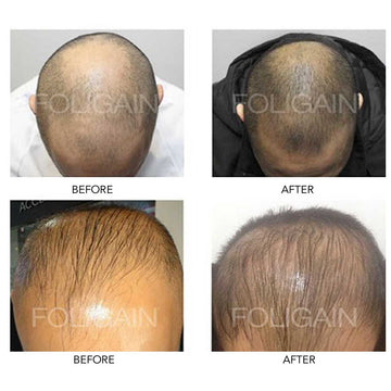 Two pairs of before-and-after photos showing thinning at the crown and front hairline.