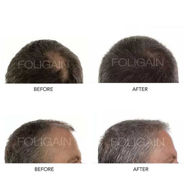 Two pairs of before-and-after photos showing the crown and hairline.