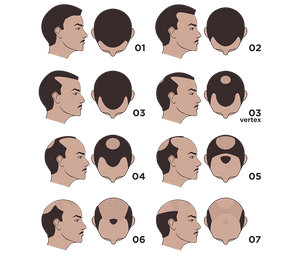 Hamilton-Norwood scale diagram showing stages 1 to 7 of male pattern hair loss.