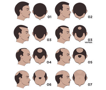 Hamilton-Norwood scale diagram showing stages 1 to 7 of male pattern hair loss.