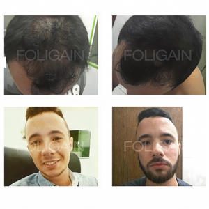 Before-and-after photos comparing scalp hair coverage and facial hair