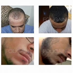 Before-and-after photos comparing hair coverage at the hairline and cheek