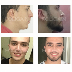 Before-and-after photos comparing beard coverage from the side and front