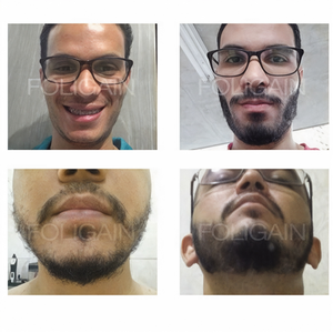 Before-and-after photos comparing beard coverage from the front and below the chin