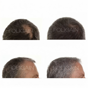 Before-and-after photos comparing hair coverage at the crown and hairline