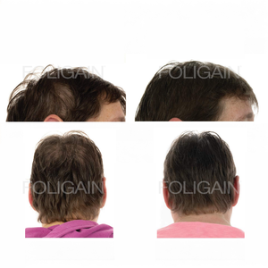 Before-and-after photos comparing hair coverage from above and behind