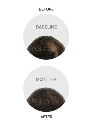 Clinical comparison photos of a crown with brown hair at baseline and month 4