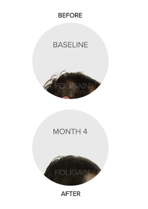 Clinical comparison photos of a crown with dark hair at baseline and month 4