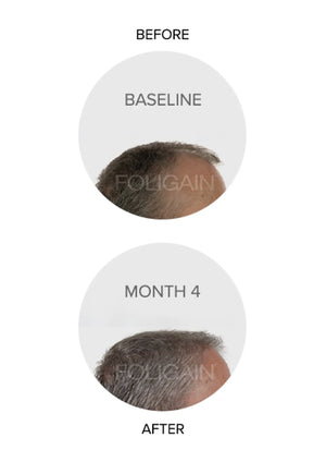 Clinical comparison photos of a graying hairline at baseline and month 4
